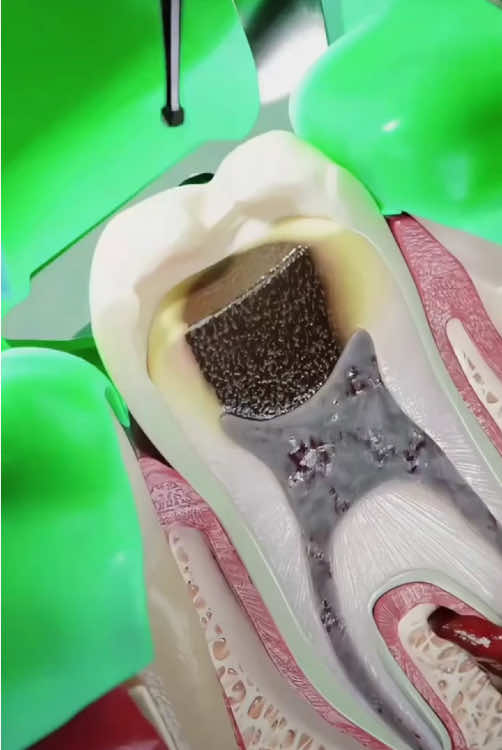 Root canal treatment (3D animation)#3Dmedicalanimation#Rootcanaltreatment#Dentalcare#Oralhealth#repairteeth 
