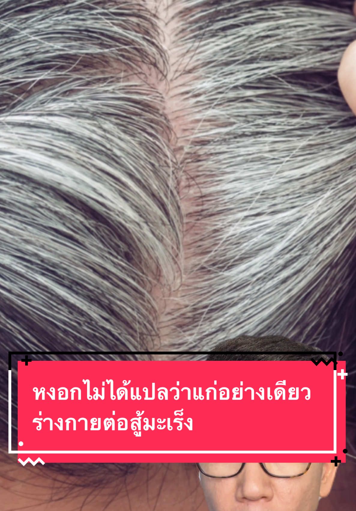 หงอกไม่ได้แปลว่าแก่อย่างเดียว แต่ร่างกายกำลังต่อสู้มะเร็ง #หงอก #ผมหงอก #มะเร็ง #ย้อมผม #j_press72 