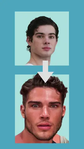 How Clavicular will look after his double jaw surgery #looksmax #clavicular #looksmaxing 