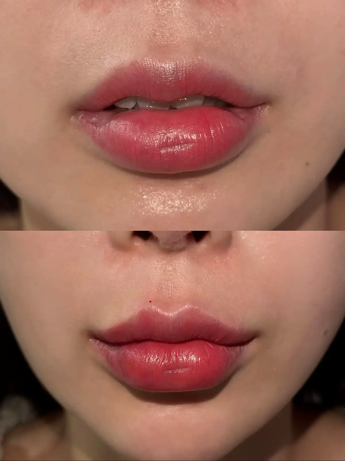 môi sẹo có tiêm đc không 🥰