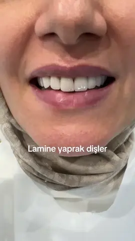 Lamine dişler#veneer #implant #viral #tiktok #diş 