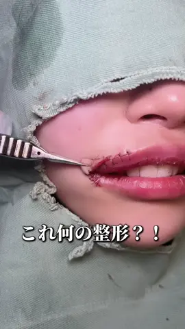これ何の整形？！ #整形 #唇整形 #口角挙上 #lip 