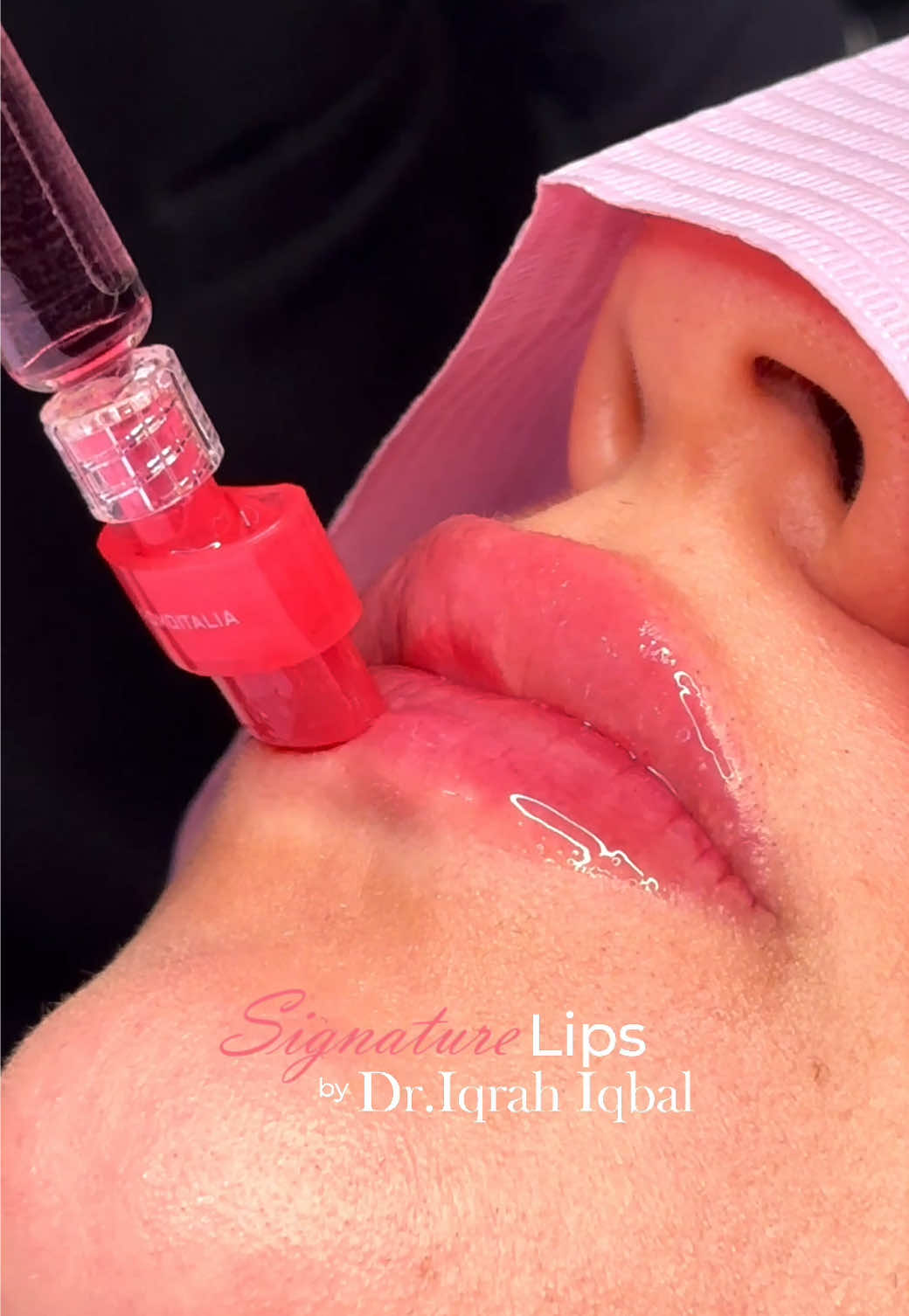 You can now up your lip game by getting promoitalia’s Bacio lip booster. Since I am the first to offer it to my patients in UAE, I deeply studied the product snd love the HA with Vitamin B12 duo. It’s perfect for hydration, collagen stimulation and pink pouty lips👄✨ Book now to avail the best introductory offers. 📱: +971585966516 📍: Lavie clinic, Dubai #lipbooster #skinboosters #skincare #beauty #fyp 