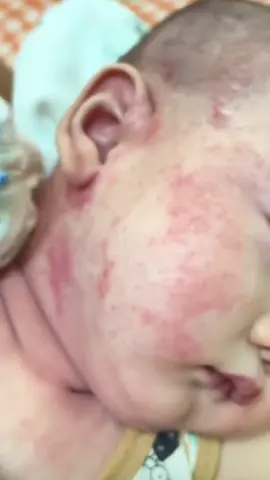 Kem dưỡng ẩm chuyên dùng cho bé viêm da cơ địa và chàm sữa, da khô nẻ bong tróc #viemdacodia #chamsua #kemduongamchobe #xuhuong 