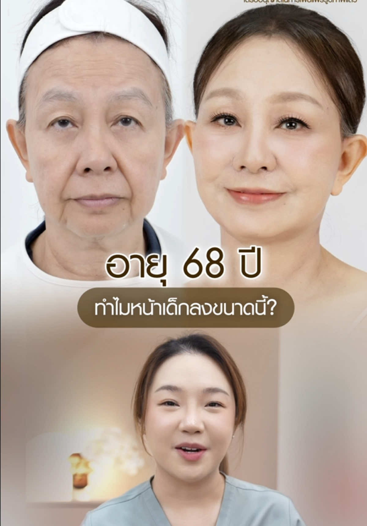 อายุ 68 ปี แต่ทำไมหน้าเด็กขนาดนี้? ในเคสรายนี้คนไข้บอกมีเวลาให้หมอเพียงแค่ 2 เดือนเท่านั้น! เพราะต้องเตรียมตัวเป็นแม่เจ้าบ่าว เคสนี้จะเป็นยังไงไปชมกันค่ะ💕💕 #หมอบีมfacialexpert #BEAMSplasticsurgery #facelift #ยกคิ้วกับหมอบีม #endotine            