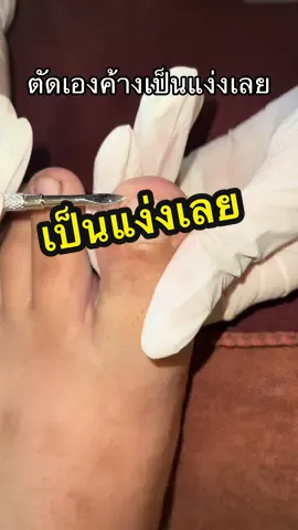 ตัดเล็บเองผิดวิธีมาอีกแล้วค่ะ#ร้านทำเล็บพิษณุโลกALLYE #cutingrowntoenail #nails #เล็บขบ #ตัดเล็บขบ 