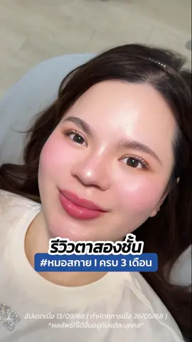 #รีวิวตาสองชั้น ครบ 3  เดือน 💖 ตาหวานเกินไปไหม😍 #หมอสกาย #skyclinic #จักษุแพทย์ #ทําตาที่ไหนดี 