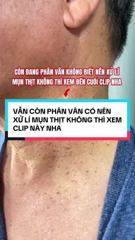 Vẫn đang phân vân có nên đốt mụn thịt không? Xem hết clip này rồi bạn sẽ hiểu vì sao ai làm xong cũng khen đáng tiền 😌 Da mịn – sáng hơn liền luôn đó 💫 #lamdepantoan #chamsocda #munthit #beautytips #fyp 