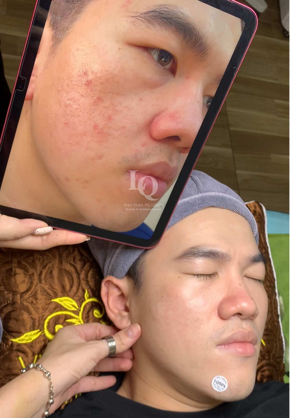 Cập nhật Sẹo#chamsocdamun#chamsocdaseo#chamsocdanam#tanbinh#Lqspa&academy