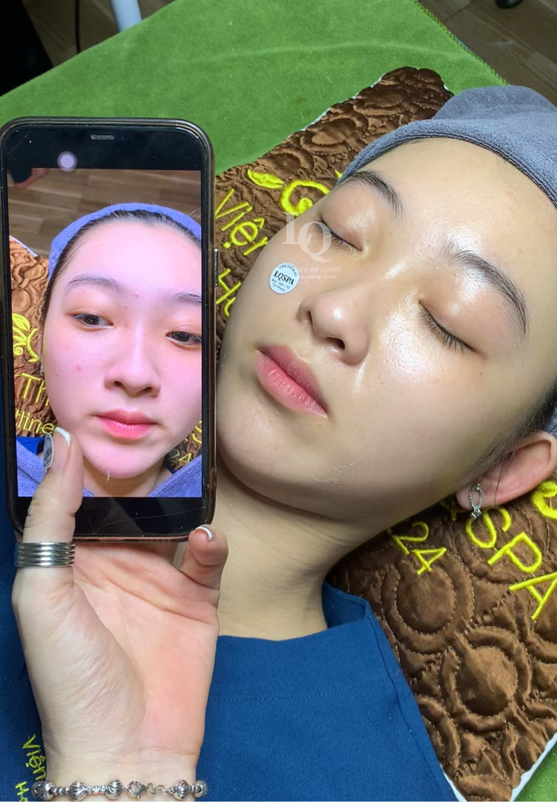 Cập nhật da peel trẻ hoá#chamsocdamun#chamsocdaseo#chamsocdanam#tanbinh#Lqspa&academy 