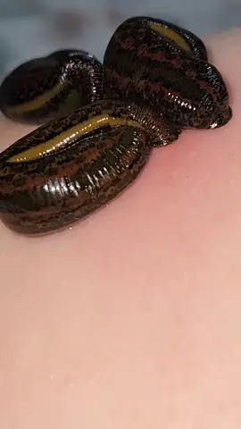 🩸 Sülüğün Salgısı (Hirudo Salgısı) Sülüklerin tedavi amacıyla kullanılmasının temel nedeni, salgılarında bulunan biyolojik olarak aktif maddelerdir. Bu salgı, sülük deriye yapıştığında kan emmeye başlarken salgılanır ve yaklaşık 100’den fazla faydalı enzim içerir. --- 🔬 Sülük Salgısındaki Önemli Maddeler ve Etkileri 1. Hirudin En bilinen ve en güçlü maddedir. Kan pıhtılaşmasını önler (doğal antikoagülan). Damar tıkanıklıklarını, varisleri ve ödemi azaltır. 2. Hyaluronidaz Doku geçirgenliğini artırır, böylece kan dolaşımı ve lenf akışı hızlanır. Doku yenilenmesini destekler. 3. Bdellin ve Eglin Antienflamatuvar (iltihap önleyici) etkisi vardır. Romatizma, eklem ağrısı, ödem ve kas iltihaplarında rahatlama sağlar. 4. Destabilaz Kan pıhtılarını çözer, damar içindeki dolaşımı düzenler. Yaraların iyileşmesini hızlandırır. 5. Hementin Fibrin yıkımını sağlar, yani pıhtı çözülmesini destekler. 6. Anestezik Maddeler Sülük ısırırken doğal uyuşturucu salgılar, bu yüzden uygulama esnasında ağrı çok az hissedilir. 7. Antibakteriyel ve Biyostimülan Maddeler Mikropların çoğalmasını engeller. Bağışıklık sistemini güçlendirir, vücutta yenilenmeyi teşvik eder. --- 🌿 Genel Etkileri Dolaşımı düzenler Ağrıyı azaltır İltihabı giderir Damar ve doku sağlığını destekler Cilt yenilenmesini teşvik eder