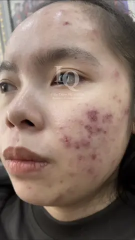 Cập nhật da mụn thâm #chamsocdamun#chamsocdaseo#chamsocdanam#tanbinh#Lqspa&academy 