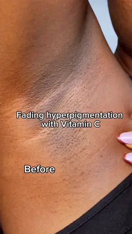 Fading hyperpigmentation with Vitamin C. Product: @Dr.Althea US Boosting Vitamin C Serum  #hyperpigmentation #vitamincserum #brighteningserum #goviral #darkspot