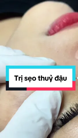 Sẹo thuỷ đậu đáp ứng với dtri tốt nhất trong các loại sẹo rỗ #triseoro #bslydalieu 