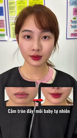 Làm hài lòng từ những khách hàng khó tính nhất #filler #botox 