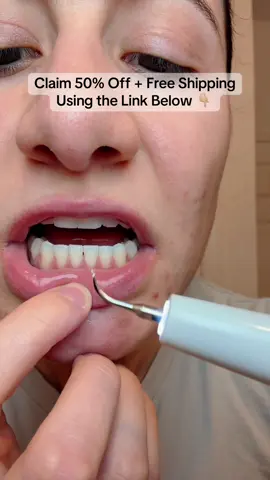 You won’t believe how much plaque this pulls off 😳✨ Rechargeable. Painless. Dentist-clean results — right at home! 🦷💎 #TartarRemover #DentalTok #CleanTeethChallenge #blackfridayearlydeals #cybermonday 