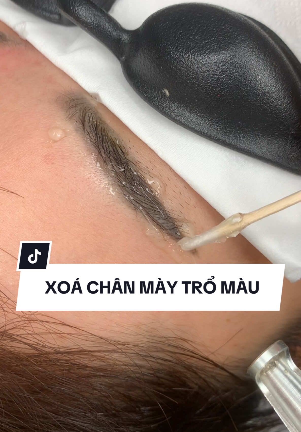 Xoá laser chân mày, hạ màu chân mày trổ màu, hút mực chân mày. #xuhuongtiktok #nguyenthuphunxam #phunxamthammy #xoasuachanmay #hamauchanmay 
