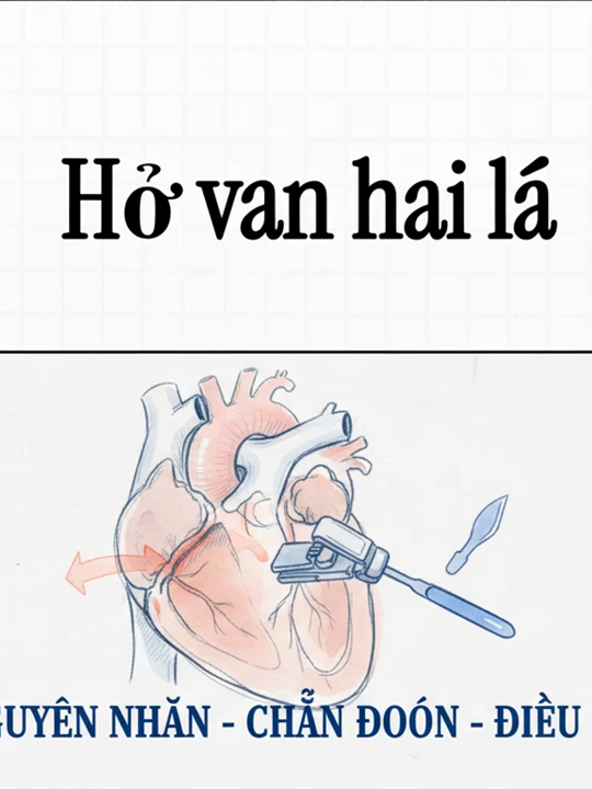 Hở van hai lá - Harrison 2025