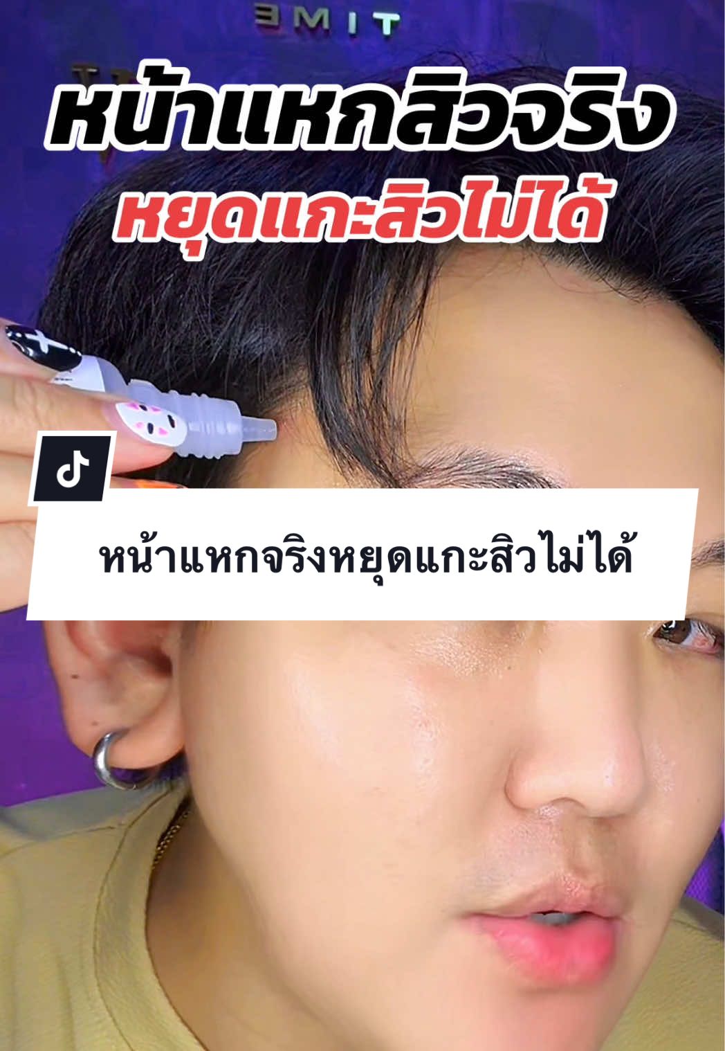 ตอบกลับ @เซลล์มิ้นท์โตโยต้าราชบุรี หน้าแหกสิวจริงหยุดแกะสิวไม่ได้ #เจลแต้มสิวเมดิต้า #เมดิต้า #สิว #tiktokshop1111ลดอลังแห่งปี #สินค้าปังดันยอดขาย 