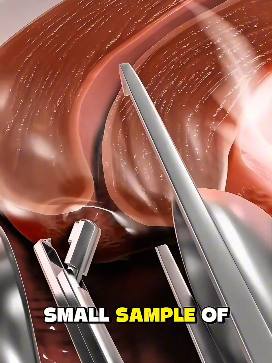 Ever wondered how cervical cancer can be detected through pap smear? #PapSmear #CervicalCancerAwareness #WomenHealth #EarlyDetection #CancerPrevention