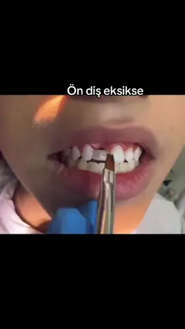 Ön diş eksikse #implant #implants #tiktok #viral 