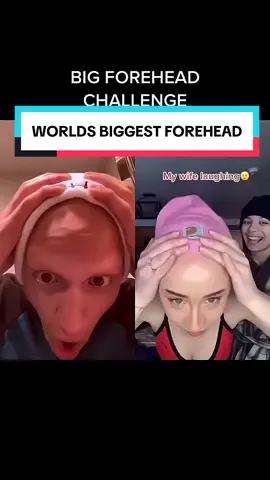 I am the CHAMPION of the big forehead challenge 😂 #comedy #funny #alopecia #challenge 