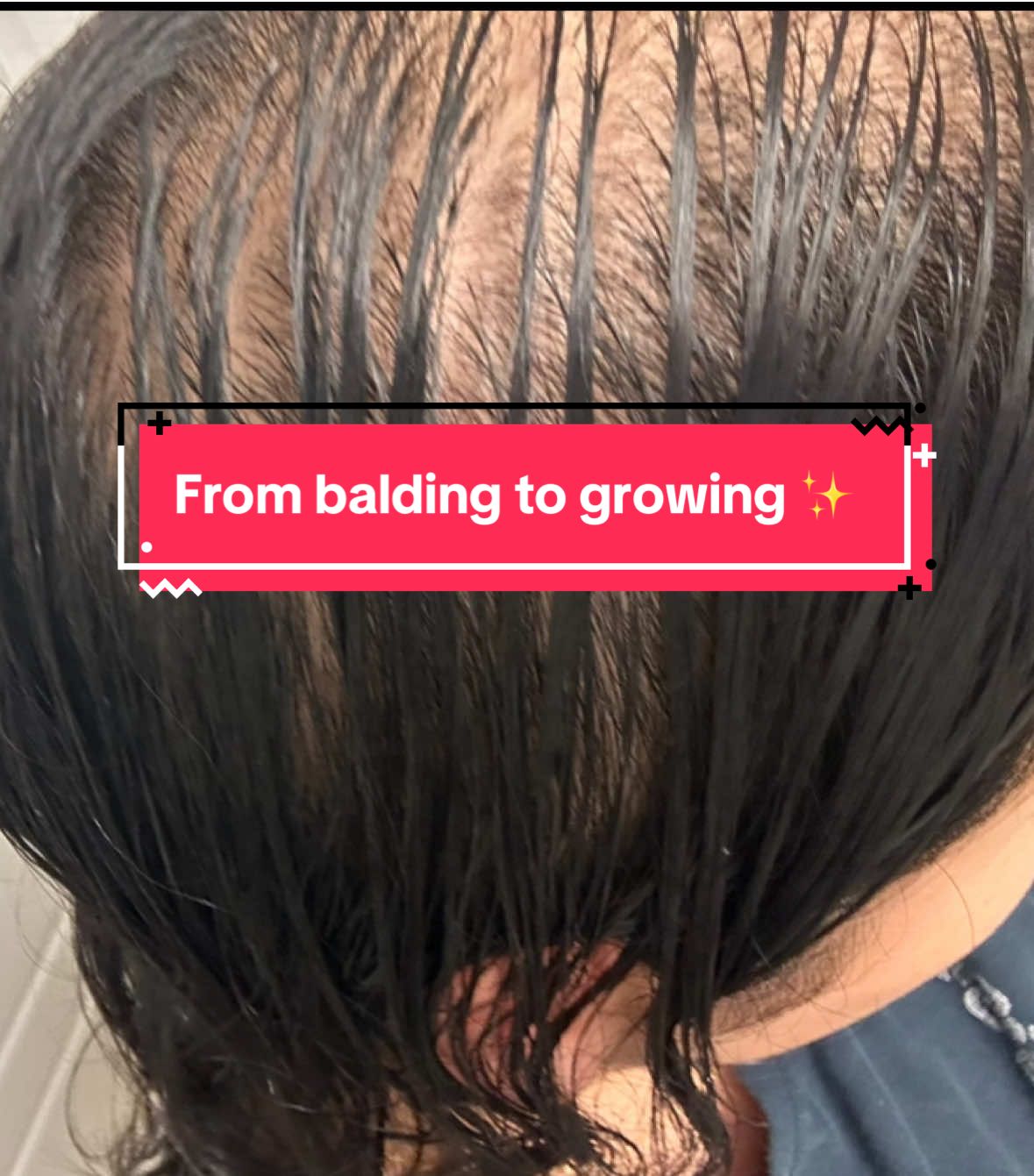 You don’t need a miracle, you need a routine ✨  #minoxidil #hairtok #hair #pcos #HairRegrowth        