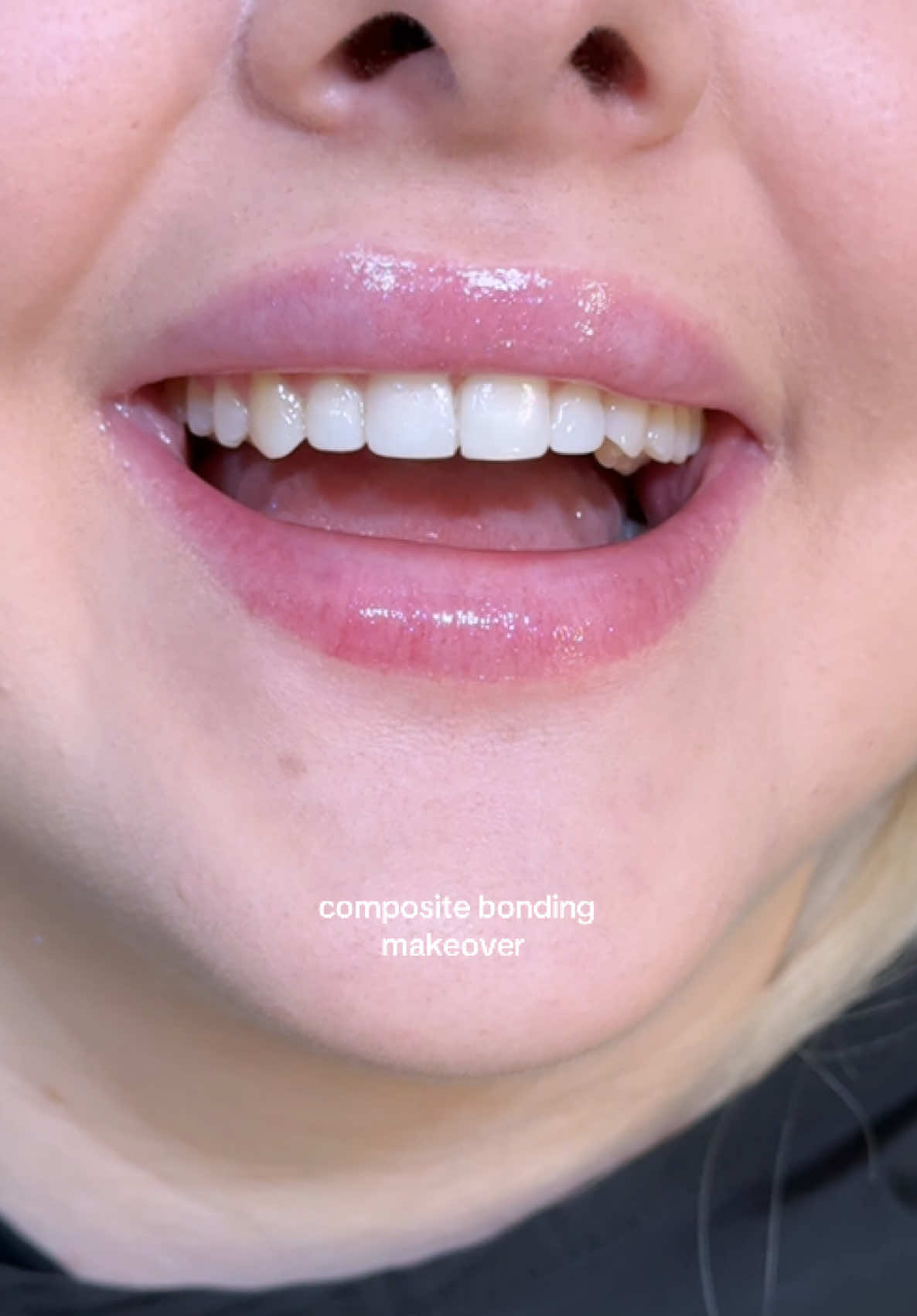 My patient travelled from Austria for composite bonding on 6 teeth (mostly edge) to correct the chipped overlapping tooth & create more even lengths whilst maintaining a natural appearance 🤍
