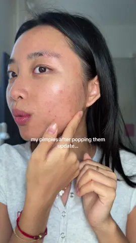 up close & personal to show yall the texture of my skin😅 #acne #pimples #acneproneskin #acnejourney 