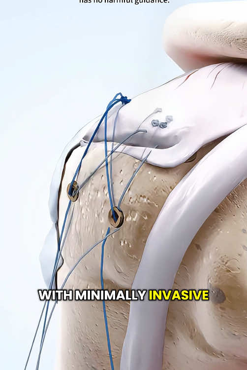 Rotator Cuff Repair Surgery (3D Animation) #rotatorcuff #rotatorcuffinjury #rotatorcufftear #rotatorcuffsurgery #rotatorcuffexercise #shouldersurgery #orthopedics #medical3danimation #3dmedicalanimation