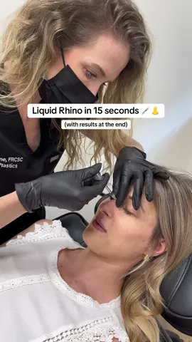 Watch @Doctor Deane perform a non-surgical rhinoplasty in just 15 seconds! 👃💉 This popular procedure uses dermal filler to subtly reshape the nose, offering immediate results without surgery or downtime. What did we achieve here? 😍 ✔️ Straightened the bridge: By precisely placing the filler above and below the dorsal hump, we instantly created a smoother, more refined nasal line. ✔️ Lifted the tip: Strategic volume at the base of the nose created a subtle upward lift and definition to the tip. ✔️ Improved profile: The subtle change corrects minor imperfections and brings the nose into greater harmony with the rest of the facial features. See how a little bit of filler can make a stunning difference? If you are interested, send us a DM! 🤍 Photos and videos published with informed written consent of the patient. Not a guarantee of results. Educational purposes only. Source: Clinique FACE MD #liquidrhinoplasty #nonsurgicalnosejob #nosefiller #dermalfiller #nosejob       