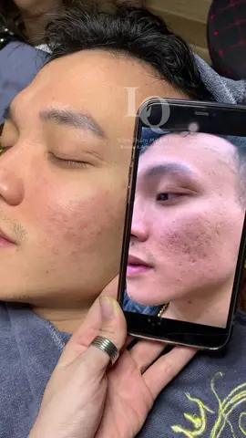 Cập nhập sẹo #chamsocdamun#chamsocdaseo#chamsocdanam#tanbinh#Lqspa&academy