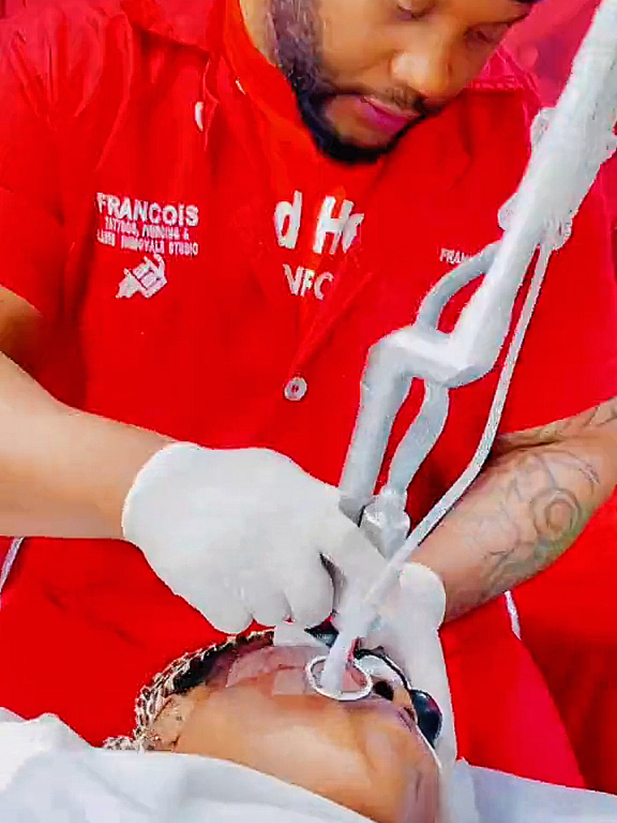 Facial treatment #francoisstudio  #creatorsearchinsights  Book for your laser resurfacing treatment, Tattoos & Piercings  Laser resurfacing is a procedure that uses a laser to improve the appearance of skin by removing the outer layers and stimulating new skin growth. It's often used to reduce wrinkles, scars, age spots, and other skin imperfections.  #scar #scartreatment #facialtreatment 