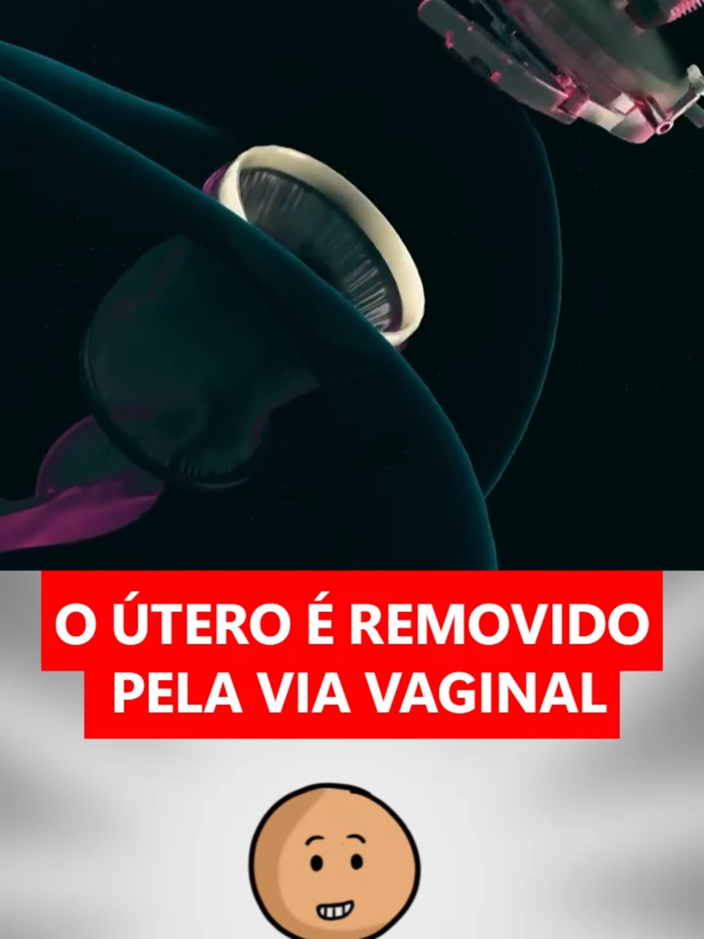 Eles Tiraram o Útero e Resolveram o Problema de Vez! 🤯 #HISTERECTOMIA #utero #saudedamulher #ginecologia #cirurgia #curiosidade #3danimacao #shorts #mulheres