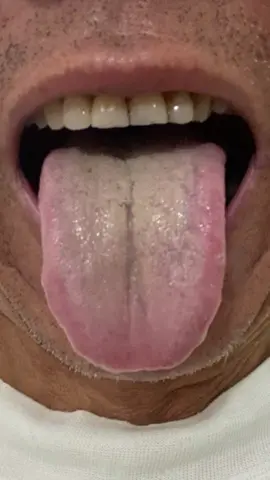 #gannhiemmo #viemdaitrang #traonguocdaday #suckhoe #xuhuong 