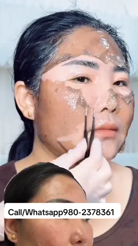 #muser #stretchmarks #musergeneretion #burnt #scar 