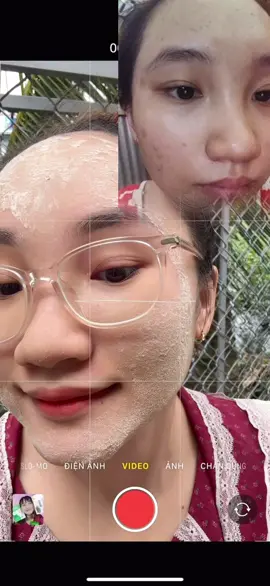 Mặt mộc e ạ #peeldatainha #tannhang #nám #mụn #yodyphuonganh 