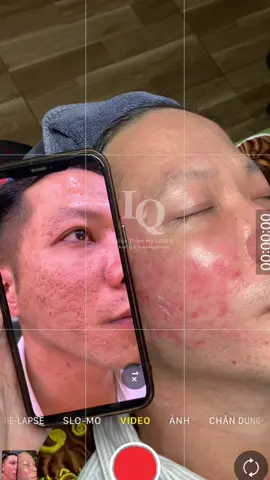 Cập nhật da Sẹo Tuần Tiếp Theo #chamsocdamun#chamsocdaseo#chamsocdanam#tanbinh#Lqspa&academy