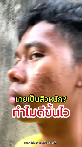 เคยเป็นสิวหนัก มาชาอัลลลอฮ 💚💚💚#ครีมขมิ้นจันทร์หอม #โทนเนอร์สมุนไพร #กันแดดมาดามลิน 