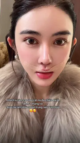 Khách iu làm combo cắt mí đa chiều đã ổn định 1 tháng rồi  Quay lại làm nhấn nhân trung siêu xinh luôn 🥰🥰  #shanghai #catmi #nhannhantrung #xhuong #mixinh 