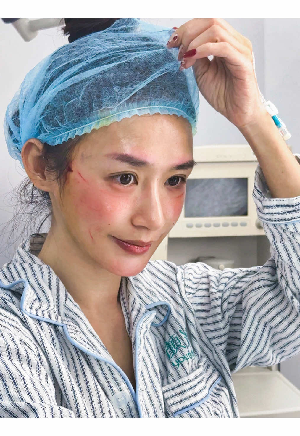 38岁，面部下垂，法令纹加深，鼓足勇气，终于来改变自己，幸运的是，效果太美啦！#面部提升 #变美逆袭 #法令纹 #面部年轻化 #上海整形 