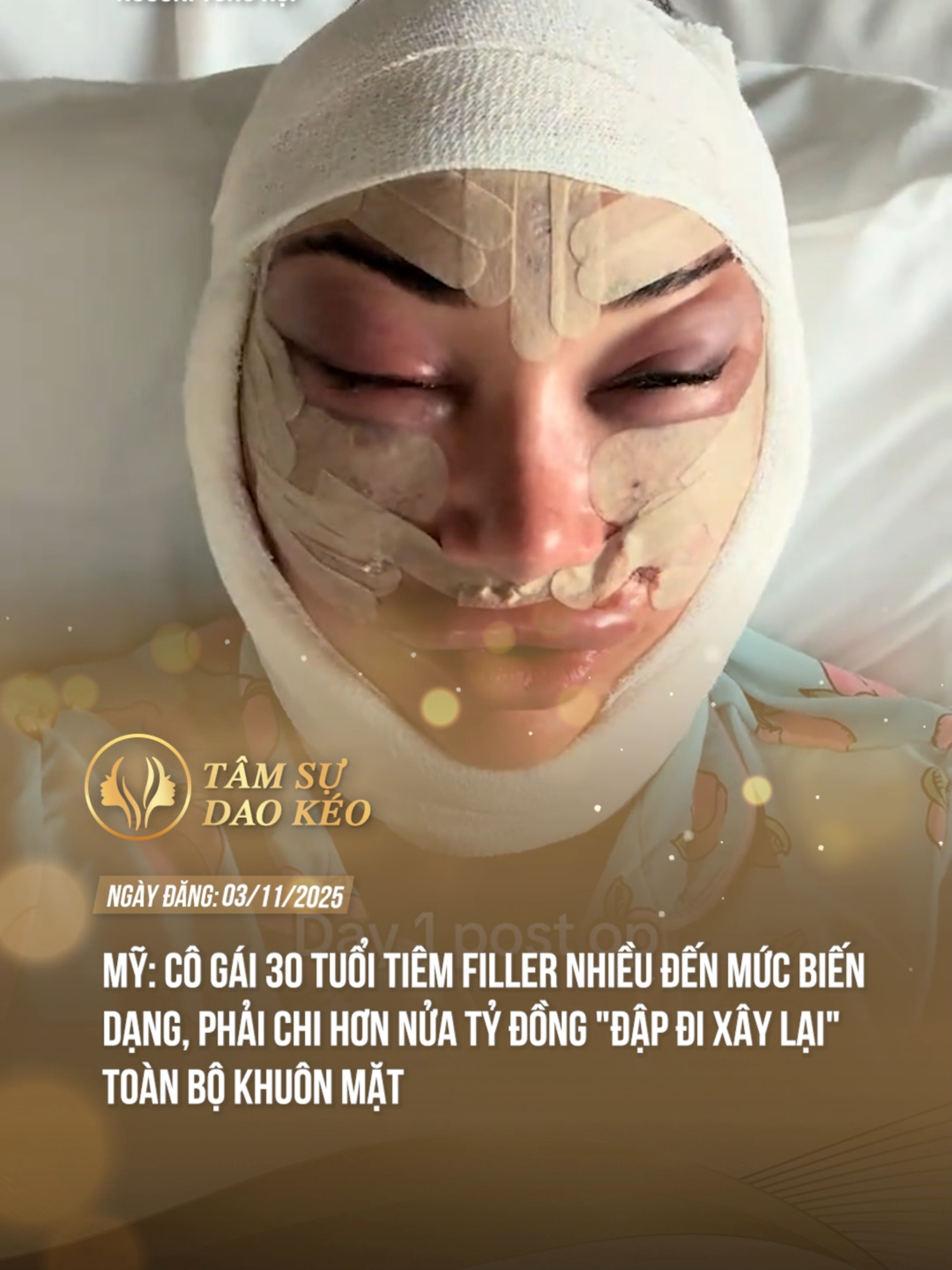 Mới 30 tuổi đã phải đi căng da mặt vì hệ luỵ tiêm filler #tamsudaokeo #theanh28 #tiktoknews #thammy #fypツ