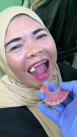 gigi palsu jenis Acrilic🦷 kualitas👉🏻 Murah tapi gak murahan #fyppppppppppppppppppppppp #bekasi #gigipalsulepasan #gigipalsuberkualitas #bekasihits 