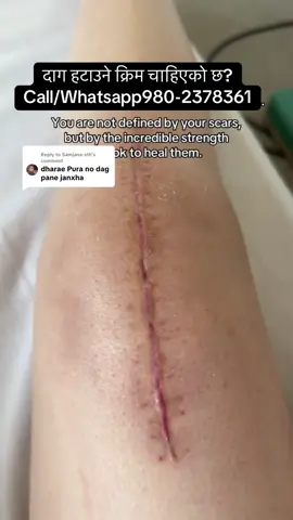 Replying to @Samjana-sth #muser #stretchmarks #stitch #burnt #scar 