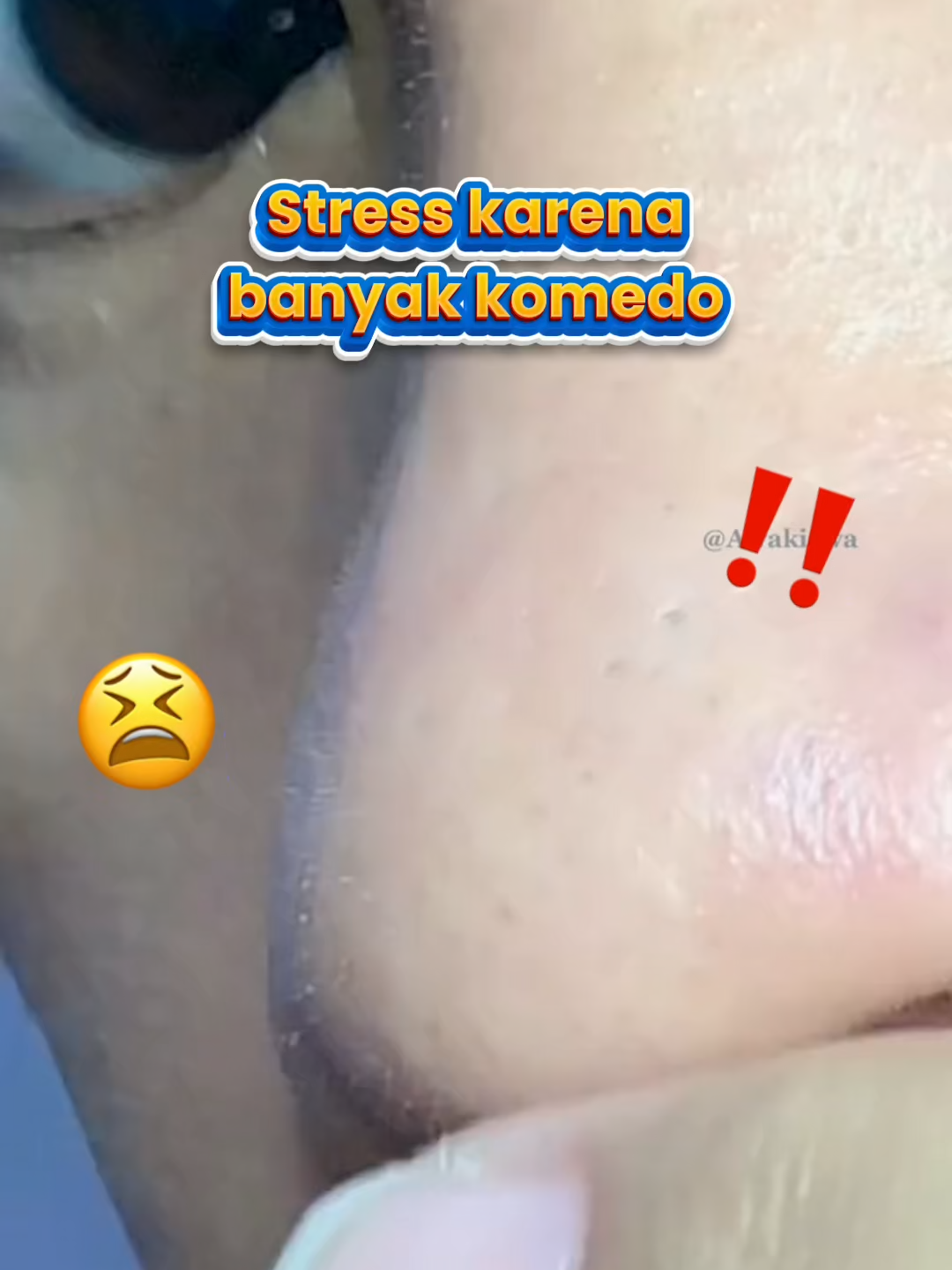 Stress nggak sih liat komedo makin banyak tiap ngaca? 😩 Tenang, nggak perlu pencet-pencet sampai sakit!! Tinggal tempel Lanbena Nose Pore Strips, tarik, dan lihat semua komedo terangkat! 💥✨ #lanbenanosemask #maskerkomedo #komedohidung #fyppppppppppppppppppppppp #blackhead