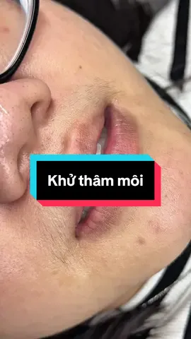 Khử thâm môi cho chị học viên đến từ Canada#khuthammoi #hutdungdichmoi #noikhuthammoiuytinsaigon #phunmoitebaogoc #suamoihuhong 