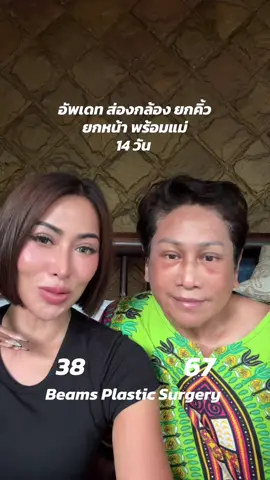 อัพเดท ส่องกล้อง ยกคิ้ว  ยกหน้า พร้อมแม่ 14 วัน @BEAMS #ยกคิ้ว #ยกหน้า 