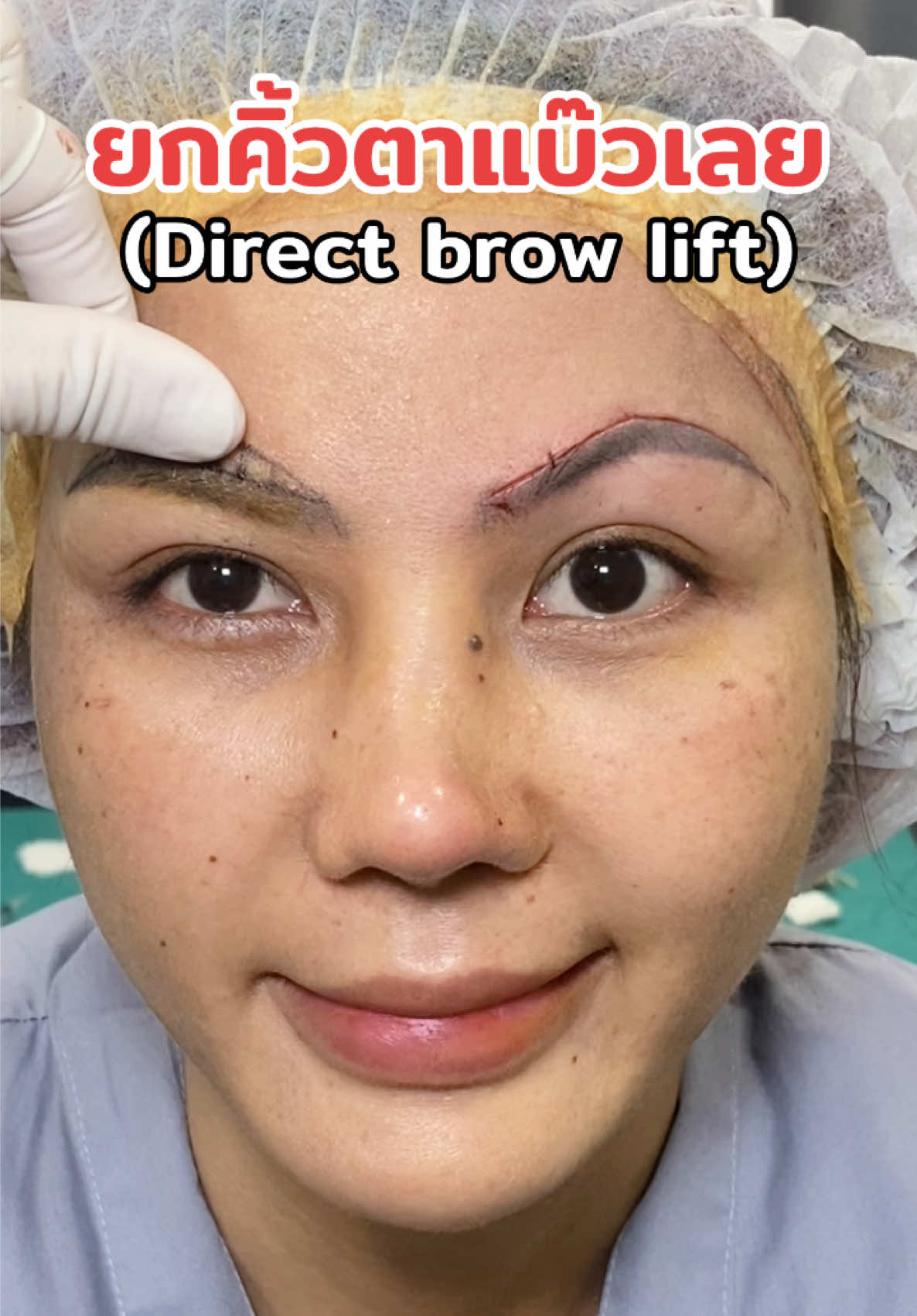 ตากลมโตแบบที่ไม่ได้ทำตาสองชั้น ด้วยโปรแกรมผ่าตัดยกคิ้ว (direct brow lift)  ✅ แก้คิ้วตก ระยะคิ้วกับตาแคบ ✅ ทรงคิ้วประเมินร่วมกับคุณหมอหญิง ✅ พักฟื้นน้อย 7 วันตัดไหม  ✅ อยู่ได้ 5-10 ปี  ✅ เย็บ Double lock  จองคิวปรึกษาคุณหมอหญิงได้เลย  ✅ :@yscclinic  ##หมอหญิงหมอคิ้ว##browlift  ##yscclinic##ยกคิ้ว ##ตาสองชั้น #ตัดถุงใต้ตา#ใต้ตา #สักคิ้ว       