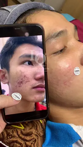 Cập nhật da sẹo#chamsocdamun#chamsocdaseo#chamsocdanam#tanbinh#Lqspa&academy 