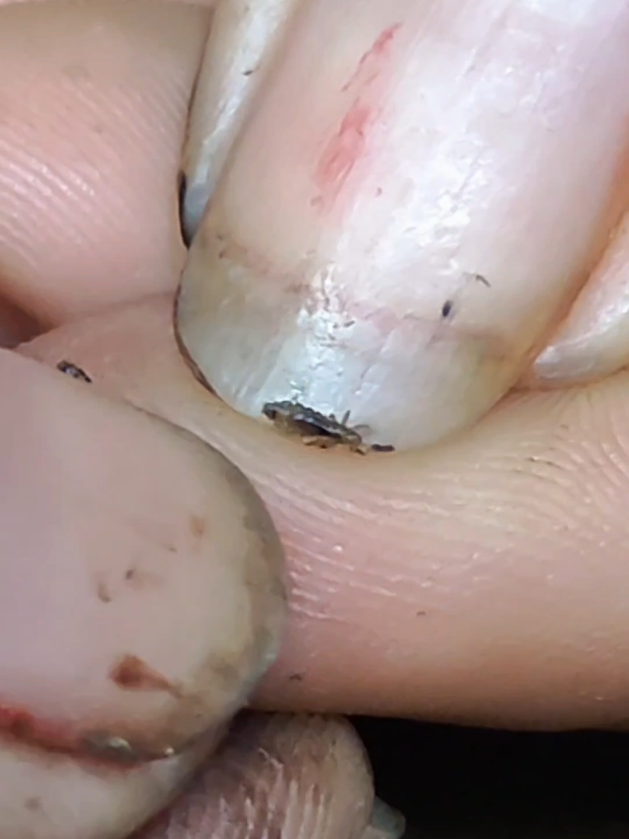 Find Lice 170 #omg #lice #tripofobia #liceremoval #licetreatment 